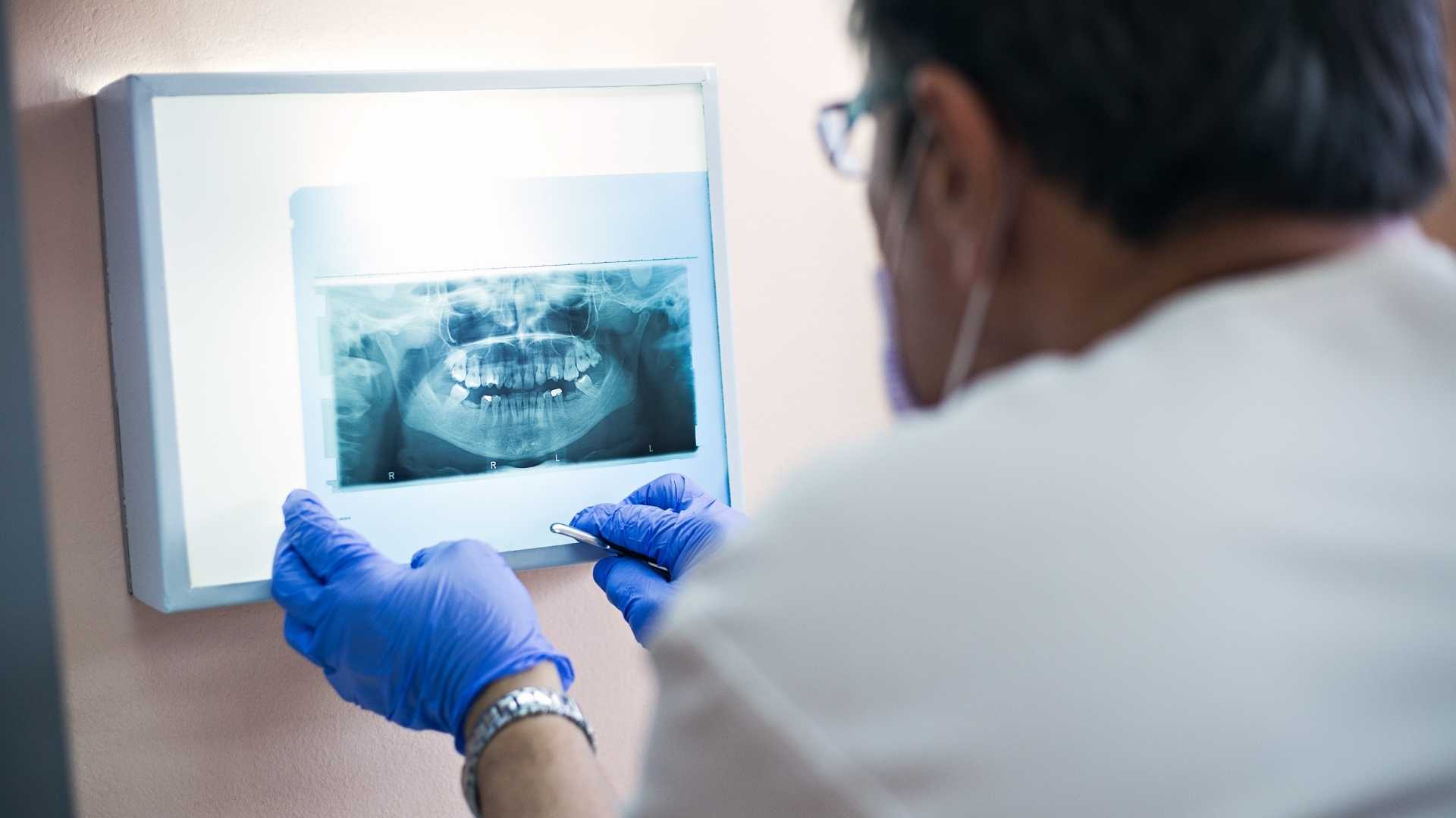 Do You Really Need to Take Dental X-Rays?